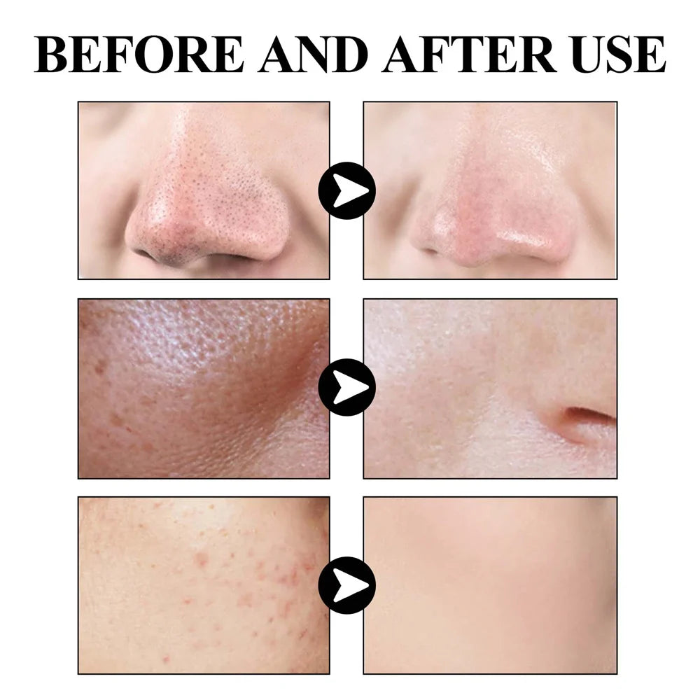 West & Month Blackhead Removal Mud Mask Deep Cleansing